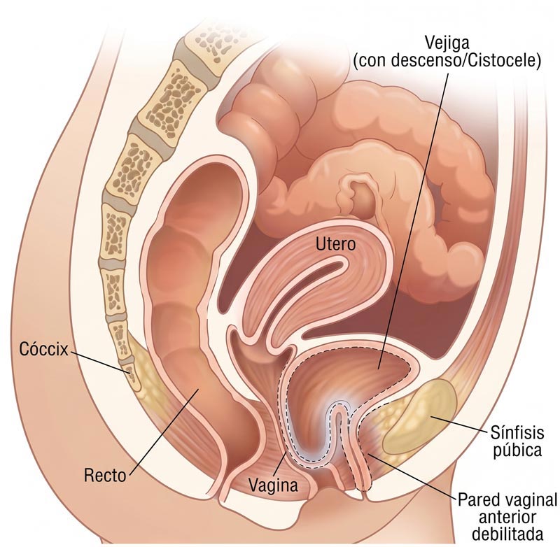 cistocele-st