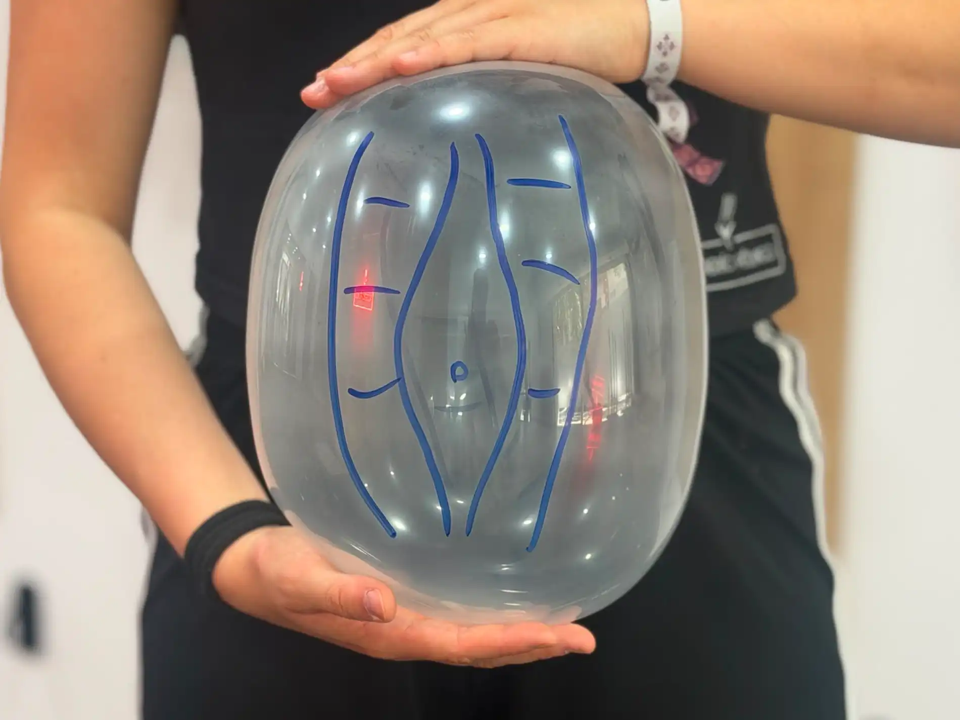 diastasis-abdominal